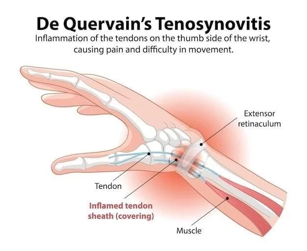 Fracturas del Quinto Metatarsiano